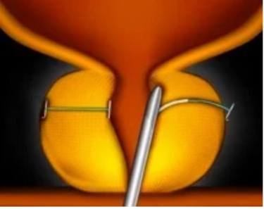 UroLift diagram - step-2