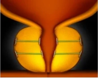 UroLift diagram step-3