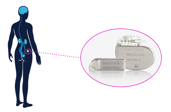 a diagram showing where in the human body the InterStim device is implanted